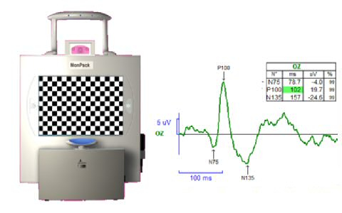 Electrophysiologie de l'oeil ERG et PEV