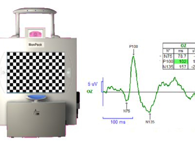 Electrophysiologie de l'oeil ERG et PEV